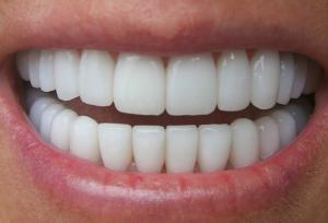 Zirconium Crowns