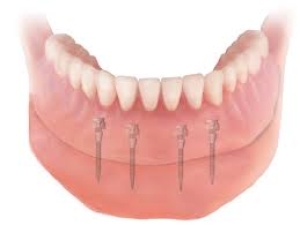 Mini Implantate