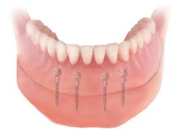 Mini Implantate
